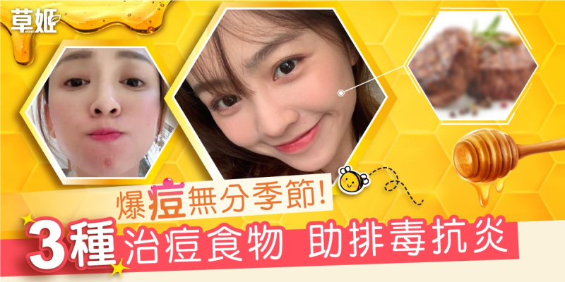 爆痘無分季節! 3種治痘食物 助排毒抗炎　