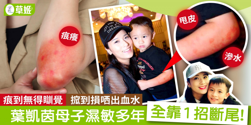 痕到無得瞓覺 搲到損哂出血水                       葉凱茵母子濕敏多年 全靠1招斷尾!