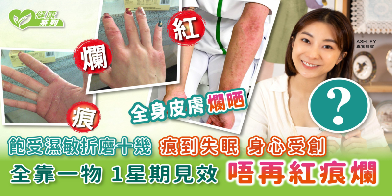 健康系列 | 飽受濕敏纏繞十幾年 痕到失眠 身心受創 | 全靠一物 1星期提升免疫力 唔再紅痕爛