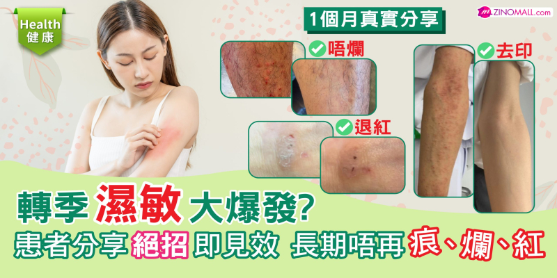 轉季濕敏大爆發？患者分享絕招即見效 長期唔再痕、爛、紅